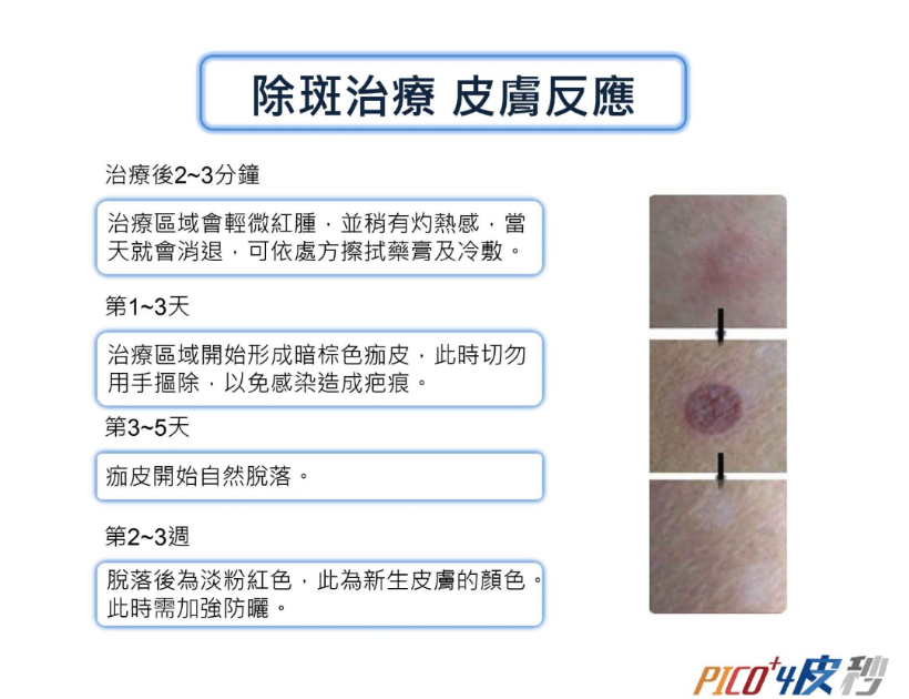 2022皮秒雷射價格|5千能做嗎?恢復期多久?皮秒雷射功效有哪些?