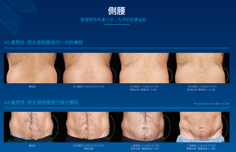 酷塑效果|瘦身新寵兒!不可錯過的酷塑冷凍減脂6大優點