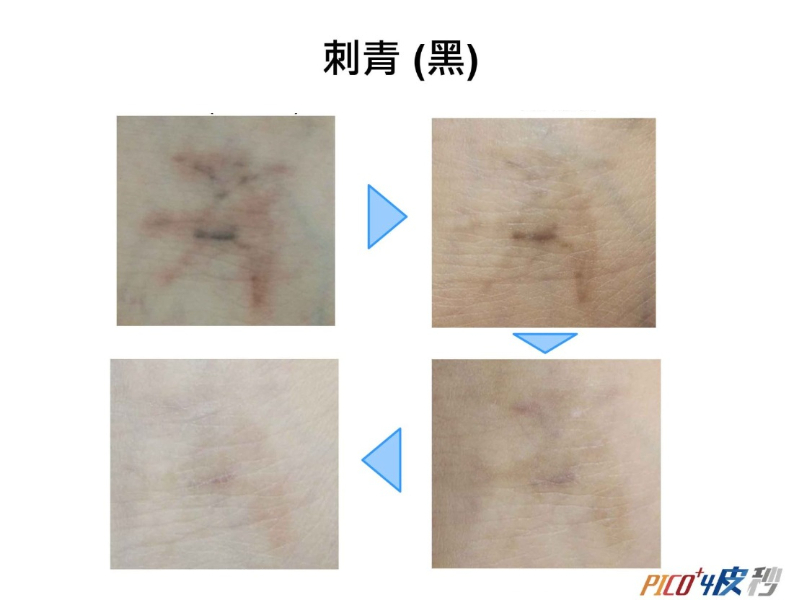 素人到女神!驚人的7大皮秒功效!但你知道皮秒是什麼嗎?