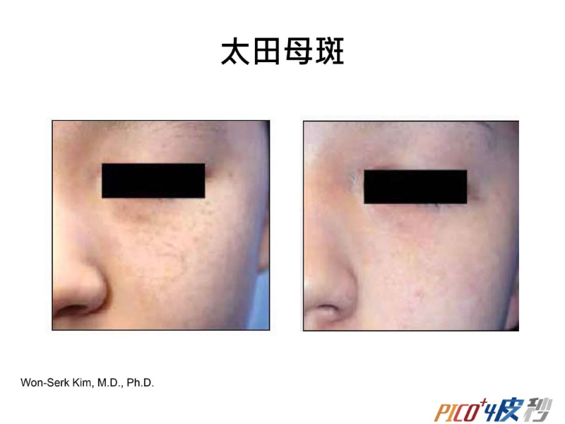 素人到女神!驚人的7大皮秒功效!但你知道皮秒是什麼嗎?