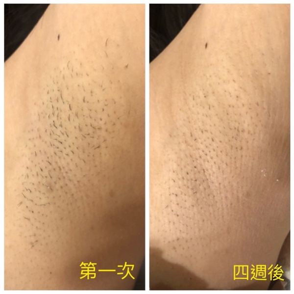 冰肌除毛效果超推薦!但冰肌除毛是什麼?【實際案例分享】