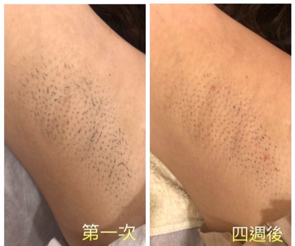 冰肌除毛效果超推薦!但冰肌除毛是什麼?【實際案例分享】
