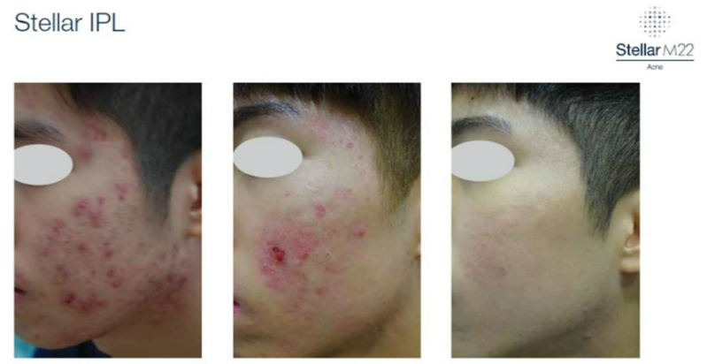 快速了解除痘疤 到底要怎麼【除痘疤?】醫美除痘效果如何?快速消除花花臉!