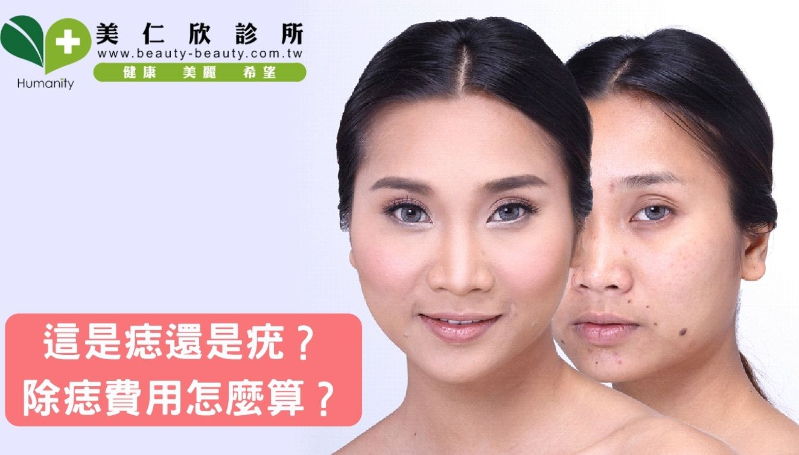 這是痣還是疣?除痣費用怎麼算