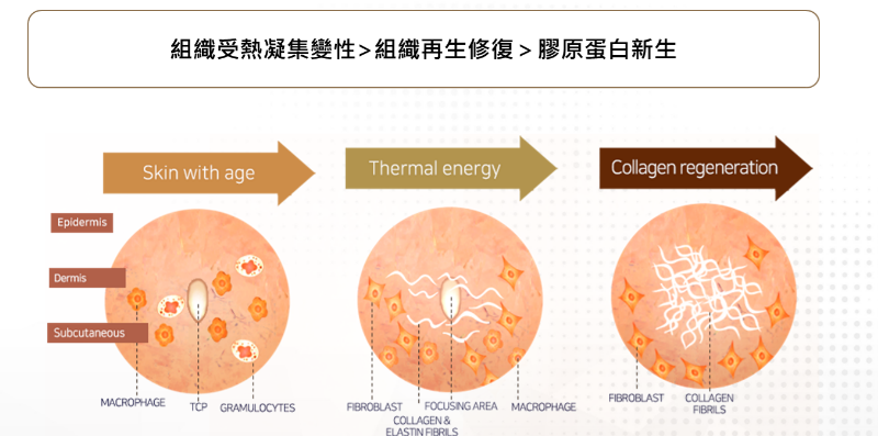 音波拉提醫美是什麼?音波拉提原理?
