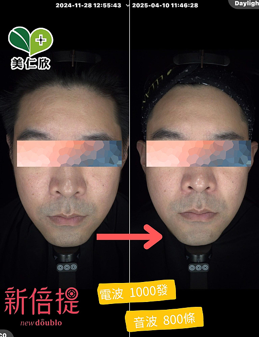 音波拉提實際案例