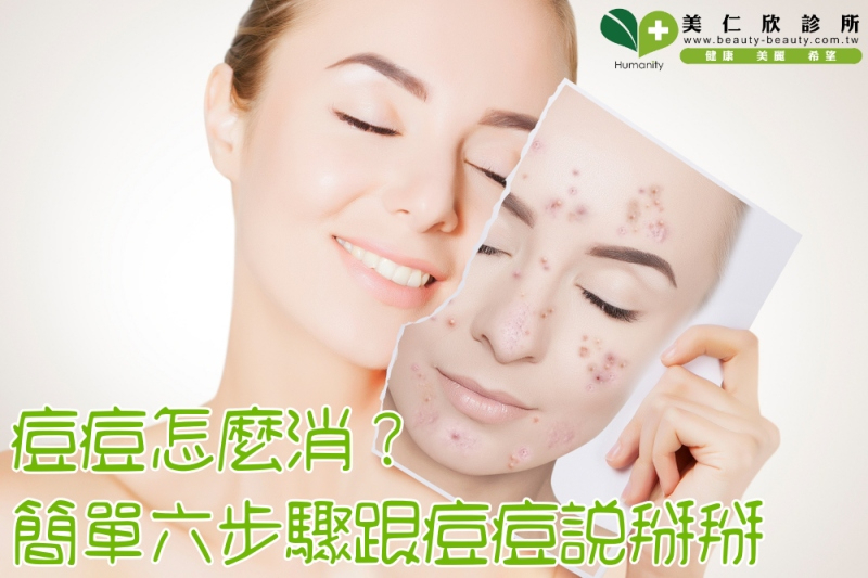 痘痘怎麼消?簡單六步驟跟痘痘說掰掰