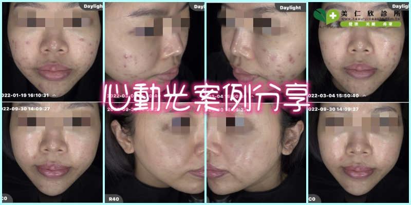 急性痘痘推薦痘痘醫美:揮別口罩痘痘肌心動光.以光養膚星動光